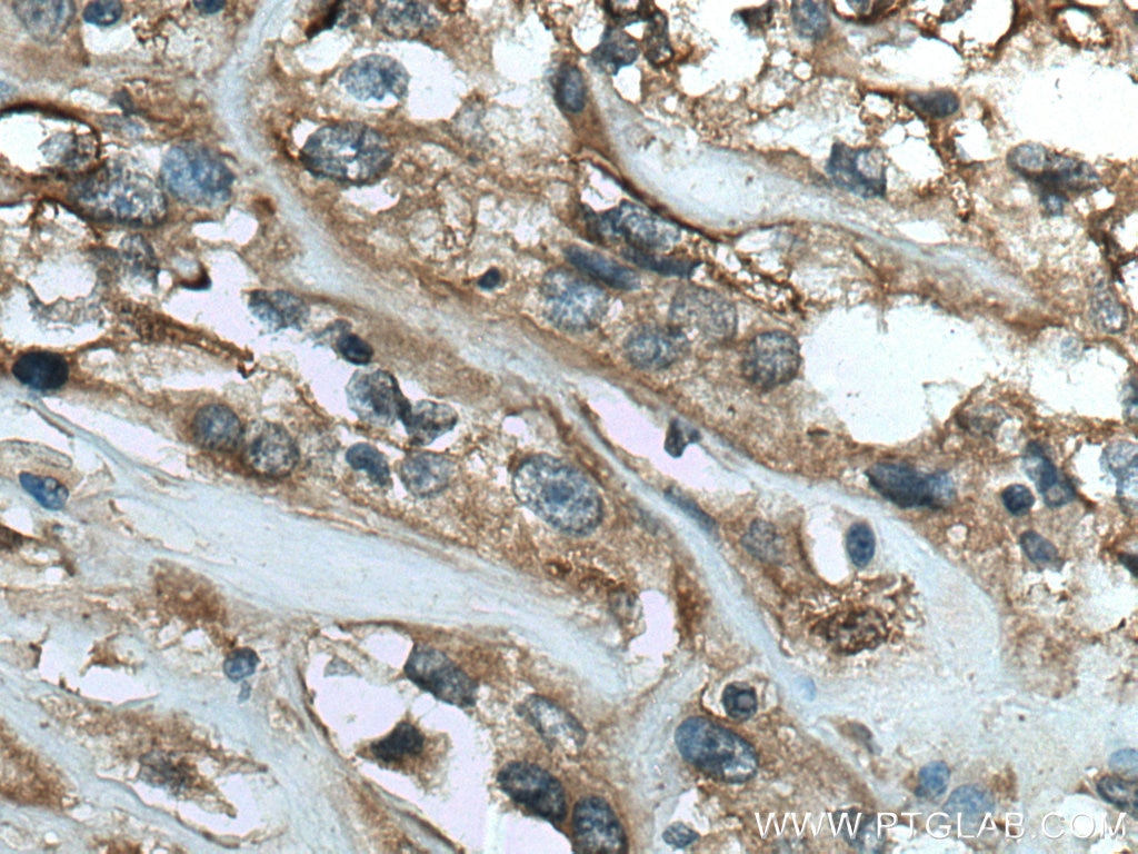 Immunohistochemistry (IHC) staining of human renal cell carcinoma tissue using SCEL Polyclonal antibody (11906-1-AP)
