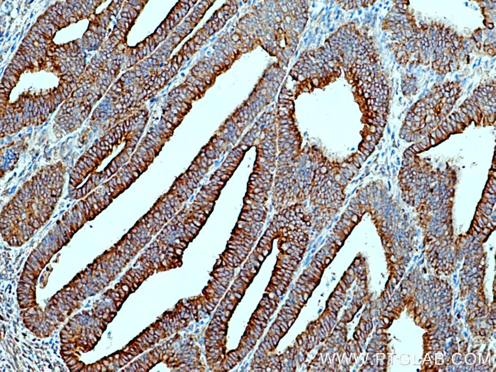 Immunohistochemistry (IHC) staining of human endometrial cancer tissue using SCFD1 Polyclonal antibody (12569-1-AP)