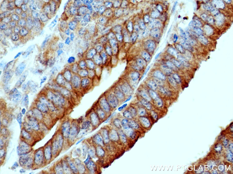 Immunohistochemistry (IHC) staining of human endometrial cancer tissue using SCFD1 Polyclonal antibody (12569-1-AP)