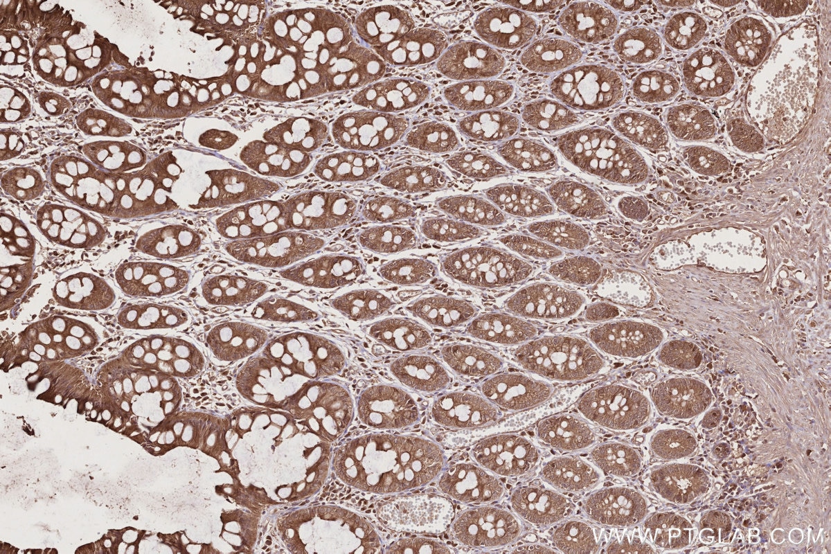 IHC staining of human rectal cancer using 12569-1-AP Immunohistochemistry (IHC) staining of human rectal cancer tissue using SCFD1 Polyclonal antibody (12569-1-AP)