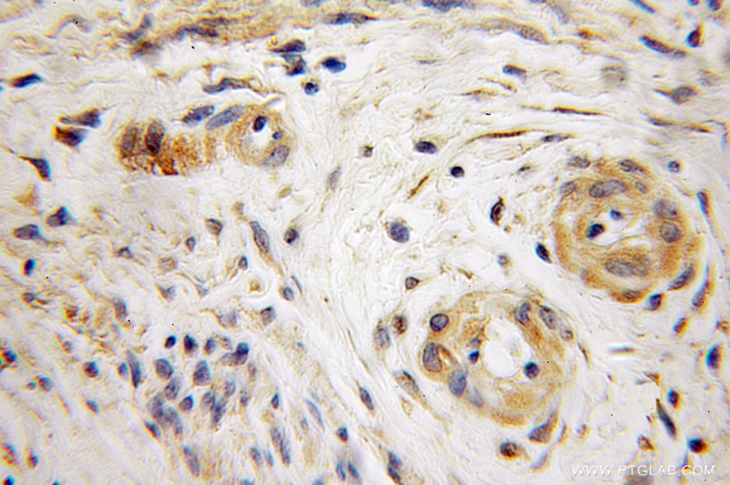 Immunohistochemistry (IHC) staining of human endometrial cancer tissue using SCFD1 Polyclonal antibody (12569-1-AP)