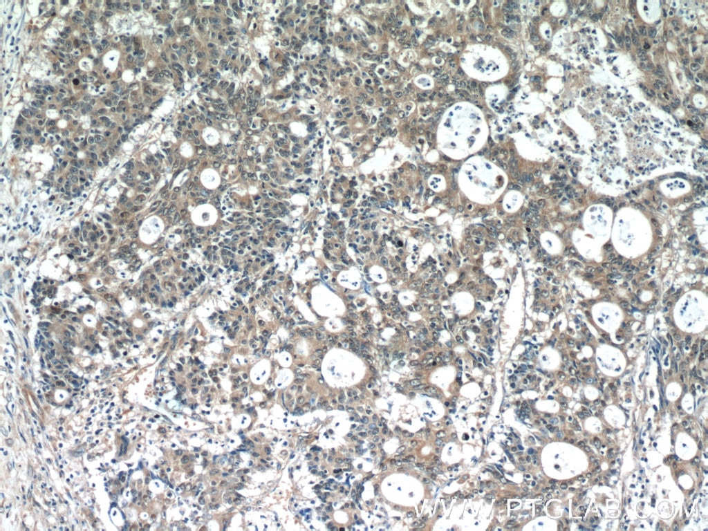 IHC staining of human colon cancer using 13375-1-AP
