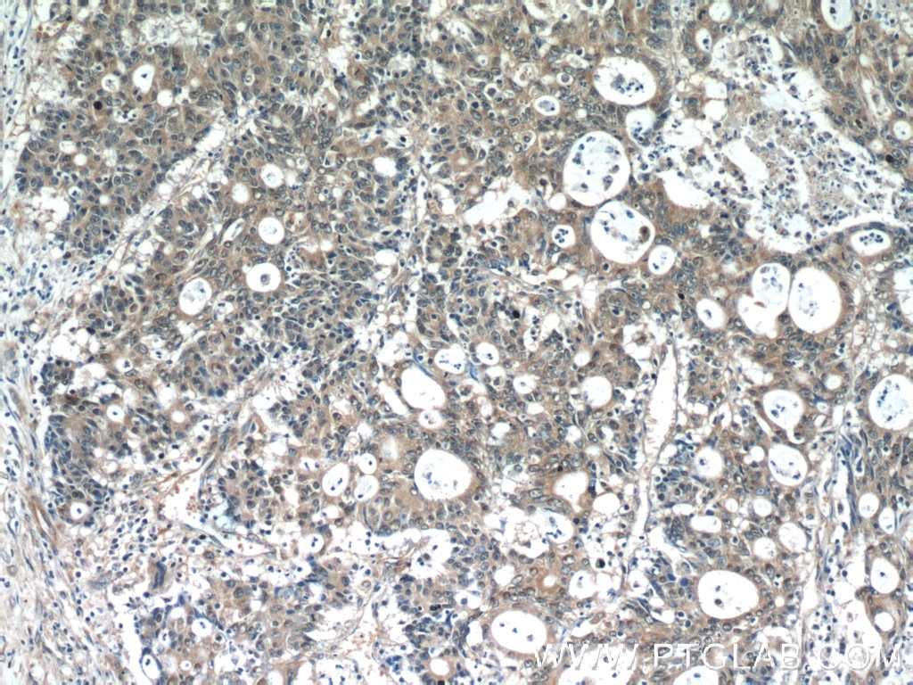 Immunohistochemistry (IHC) staining of human colon cancer tissue using SCFD2 Polyclonal antibody (13375-1-AP)