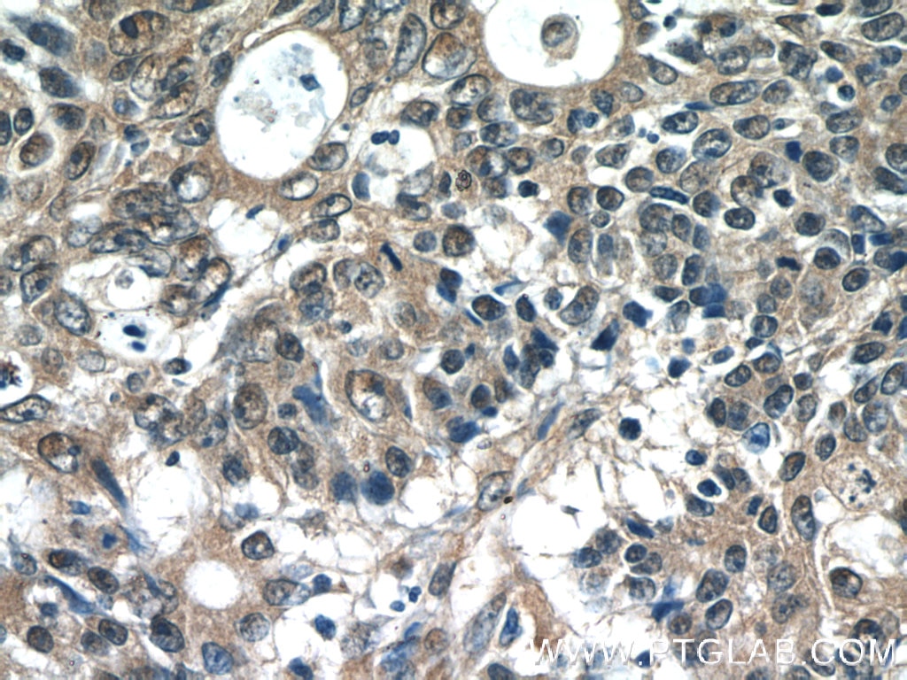 Immunohistochemistry (IHC) staining of human colon cancer tissue using SCFD2 Polyclonal antibody (13375-1-AP)
