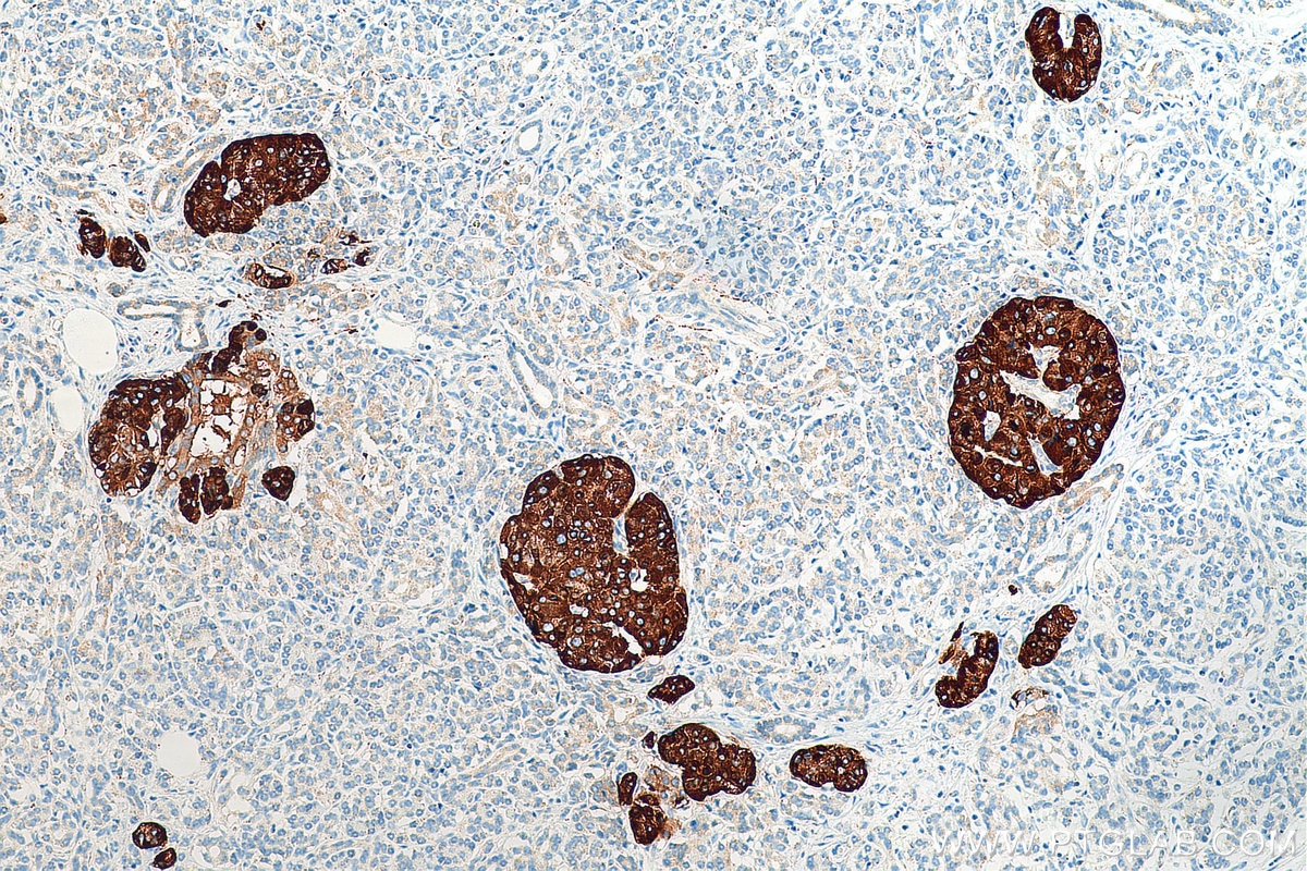 Immunohistochemistry (IHC) staining of human pancreas cancer tissue using Secretogranin III Polyclonal antibody (10954-1-AP)