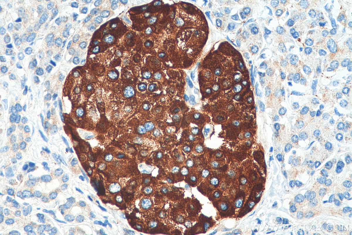 Immunohistochemistry (IHC) staining of human pancreas cancer tissue using Secretogranin III Polyclonal antibody (10954-1-AP)