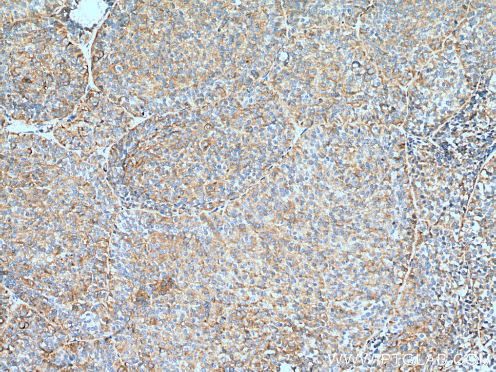 Immunohistochemistry (IHC) staining of human pituitary adenoma tissue using Secretogranin V Polyclonal antibody (10761-1-AP)