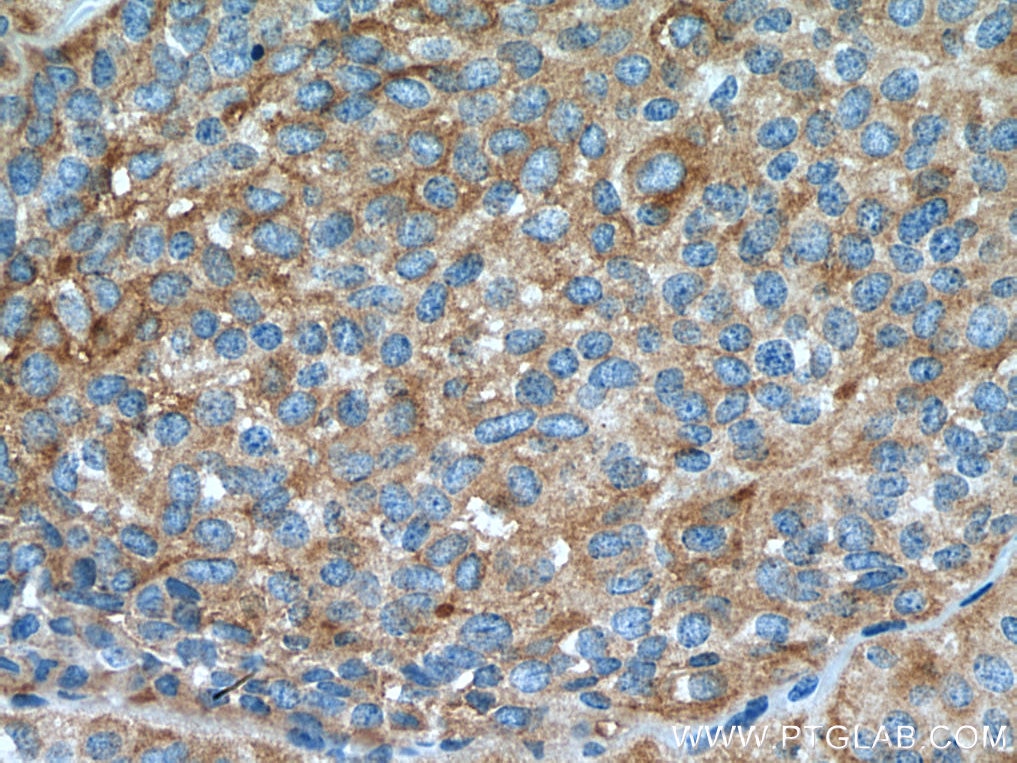 Immunohistochemistry (IHC) staining of human pituitary adenoma tissue using Secretogranin V Polyclonal antibody (10761-1-AP)