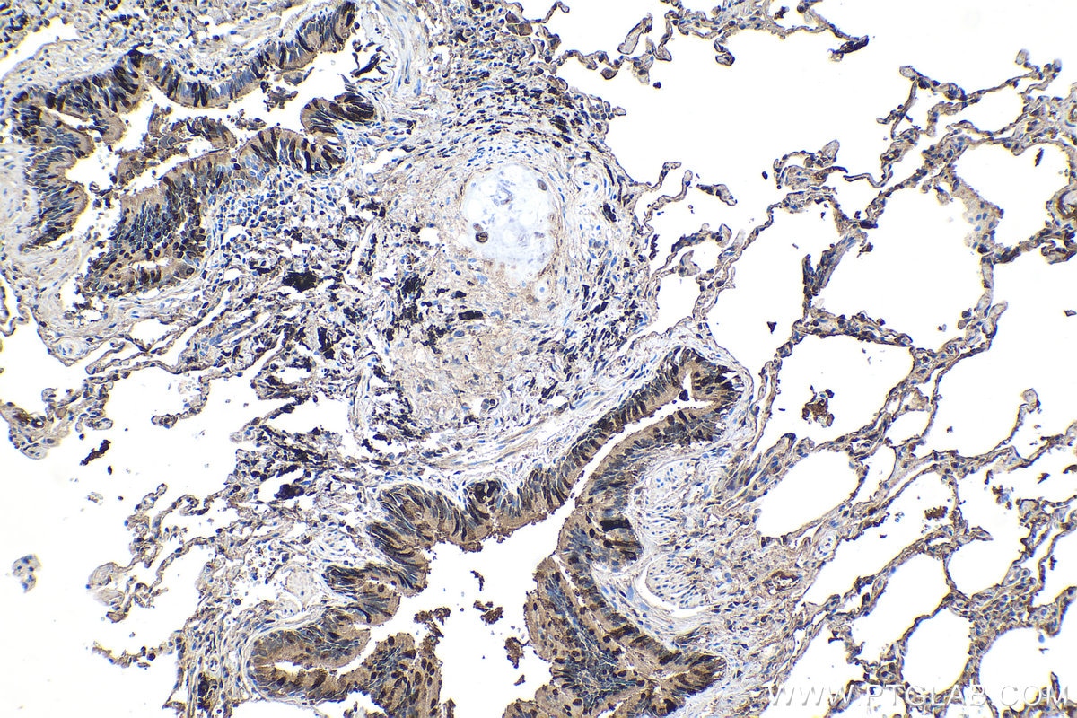 Immunohistochemistry (IHC) staining of human lung cancer tissue using Uteroglobin/CC10 Polyclonal antibody (10490-1-AP)