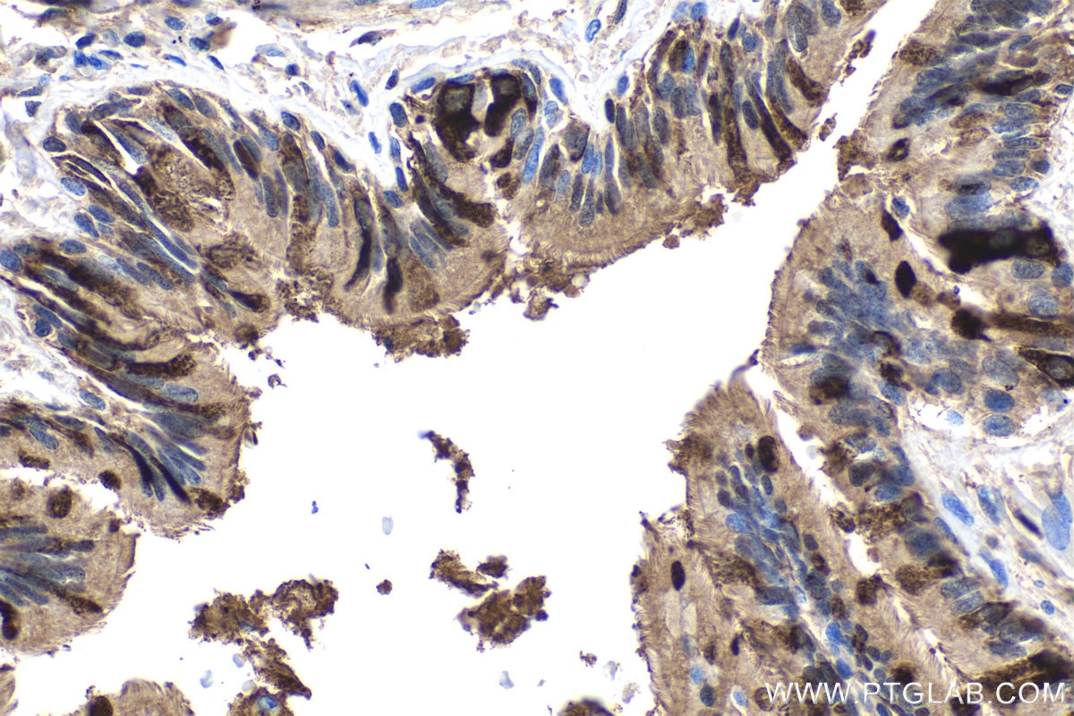 Immunohistochemistry (IHC) staining of human lung cancer tissue using Uteroglobin/CC10 Polyclonal antibody (10490-1-AP)