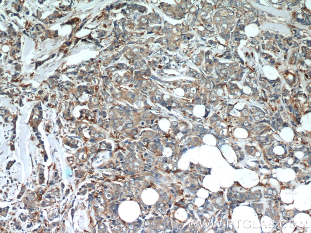 Immunohistochemistry (IHC) staining of human breast cancer tissue using Mammaglobin A Polyclonal antibody (23501-1-AP)