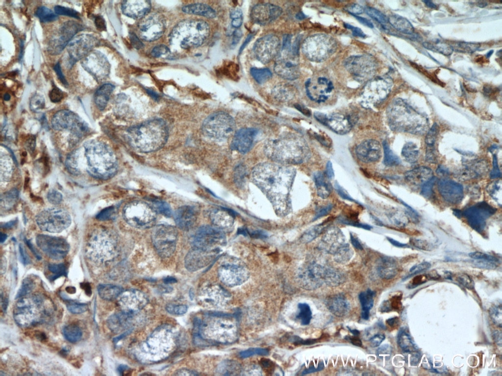 Immunohistochemistry (IHC) staining of human breast cancer tissue using Mammaglobin A Polyclonal antibody (23501-1-AP)