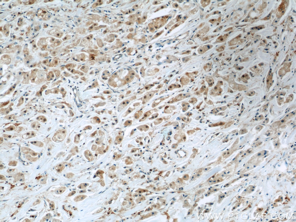 Immunohistochemistry (IHC) staining of human breast cancer tissue using Mammaglobin A Polyclonal antibody (23501-1-AP)