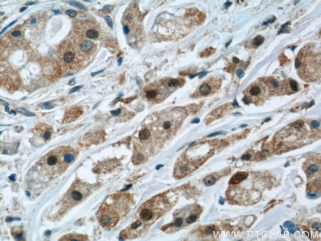 Immunohistochemistry (IHC) staining of human breast cancer tissue using Mammaglobin A Polyclonal antibody (23501-1-AP)
