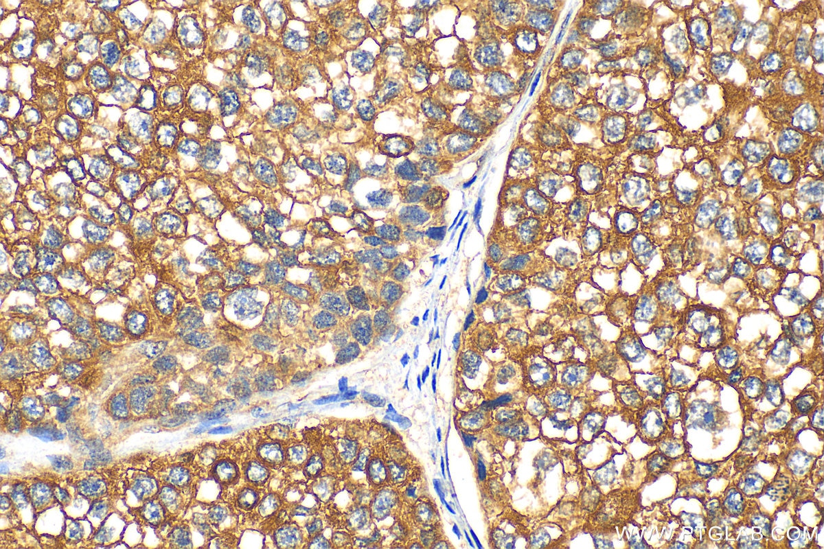 Immunohistochemistry (IHC) staining of human breast cancer tissue using Mammaglobin A Polyclonal antibody (23501-1-AP)