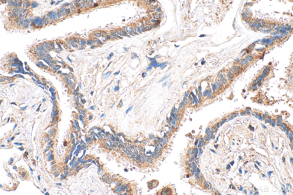 IHC staining of human lung using 34191-1-AP (same clone as 34191-1-PBS) Immunohistochemistry (IHC) staining of human lung tissue using SCGB3A1 Polyclonal antibody (34191-1-AP)