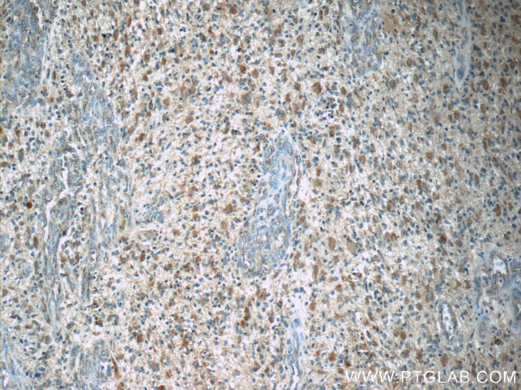 Immunohistochemistry (IHC) staining of human gliomas tissue using SCGBL Polyclonal antibody (21142-1-AP)