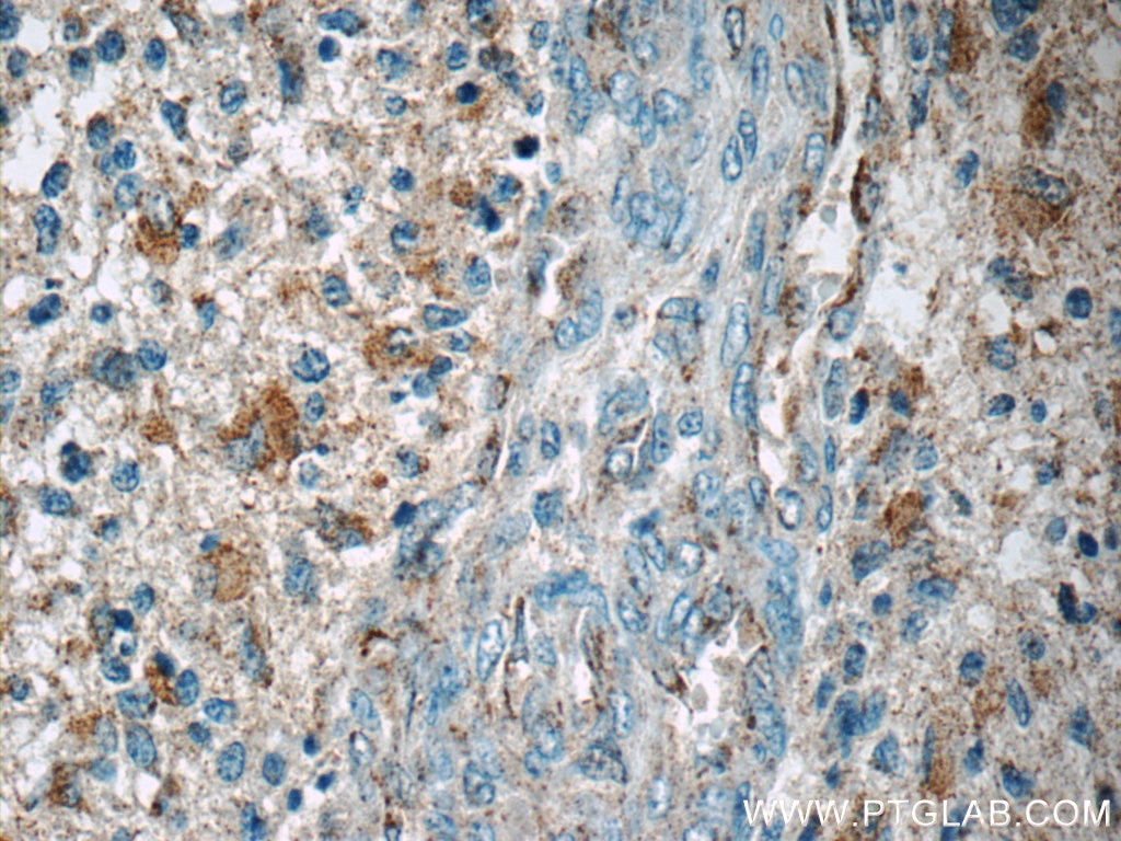 Immunohistochemistry (IHC) staining of human gliomas tissue using SCGBL Polyclonal antibody (21142-1-AP)