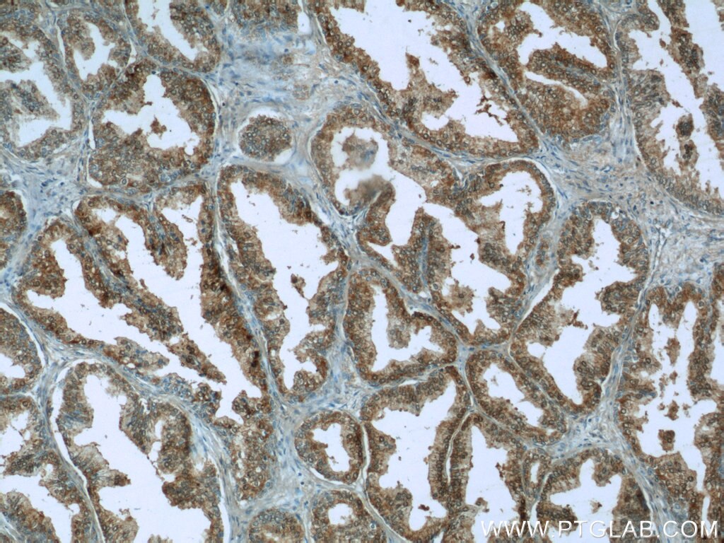 Immunohistochemistry (IHC) staining of human prostate hyperplasia tissue using SCGBL Polyclonal antibody (21142-1-AP)