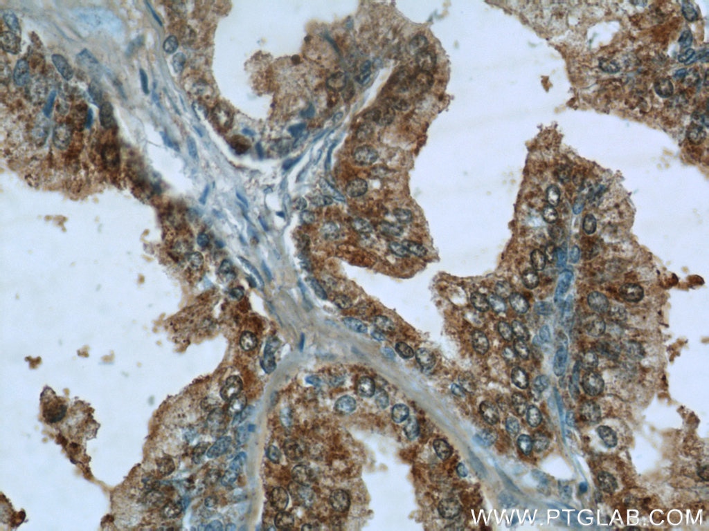 Immunohistochemistry (IHC) staining of human prostate hyperplasia tissue using SCGBL Polyclonal antibody (21142-1-AP)