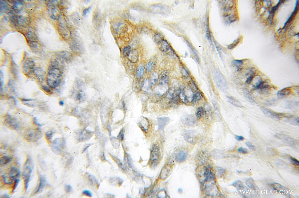 Immunohistochemistry (IHC) staining of human pancreas cancer tissue using SCIN Polyclonal antibody (11579-1-AP)