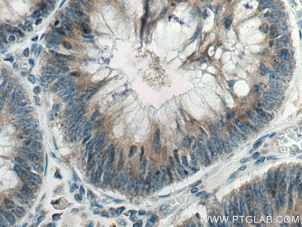 Immunohistochemistry (IHC) staining of human colon cancer tissue using SCLT1 Polyclonal antibody (14875-1-AP)