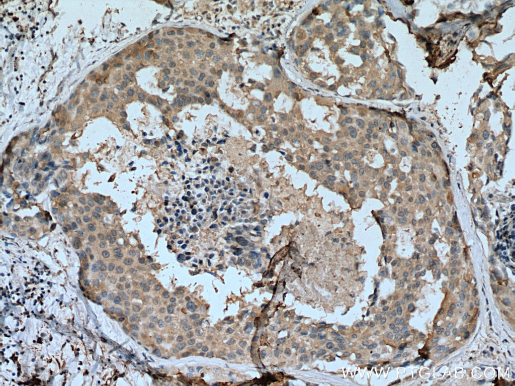 Immunohistochemistry (IHC) staining of human breast cancer tissue using SCLY Monoclonal antibody (67606-1-Ig)