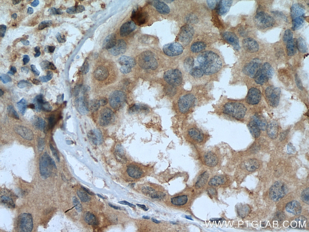 Immunohistochemistry (IHC) staining of human breast cancer tissue using SCLY Monoclonal antibody (67606-1-Ig)