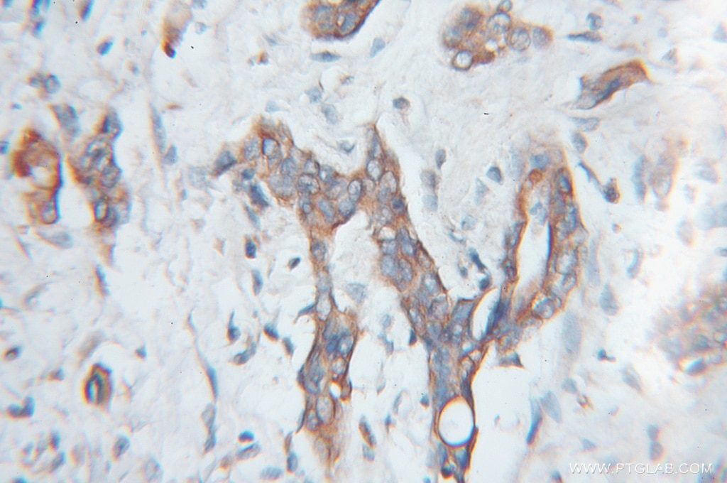 Immunohistochemistry (IHC) staining of human pancreas cancer tissue using SCMH1 Polyclonal antibody (11489-1-AP)