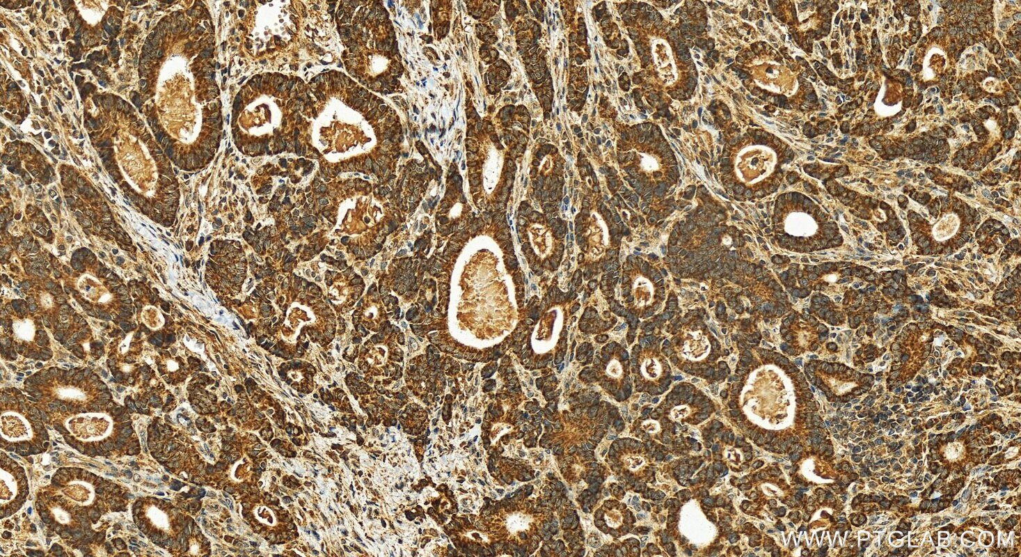 Immunohistochemistry (IHC) staining of human stomach cancer tissue using SCO1 Polyclonal antibody (12614-1-AP)