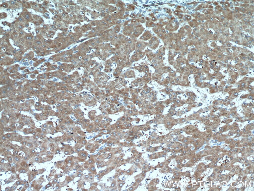 IHC staining of human hepatocirrhosis using 21223-1-AP