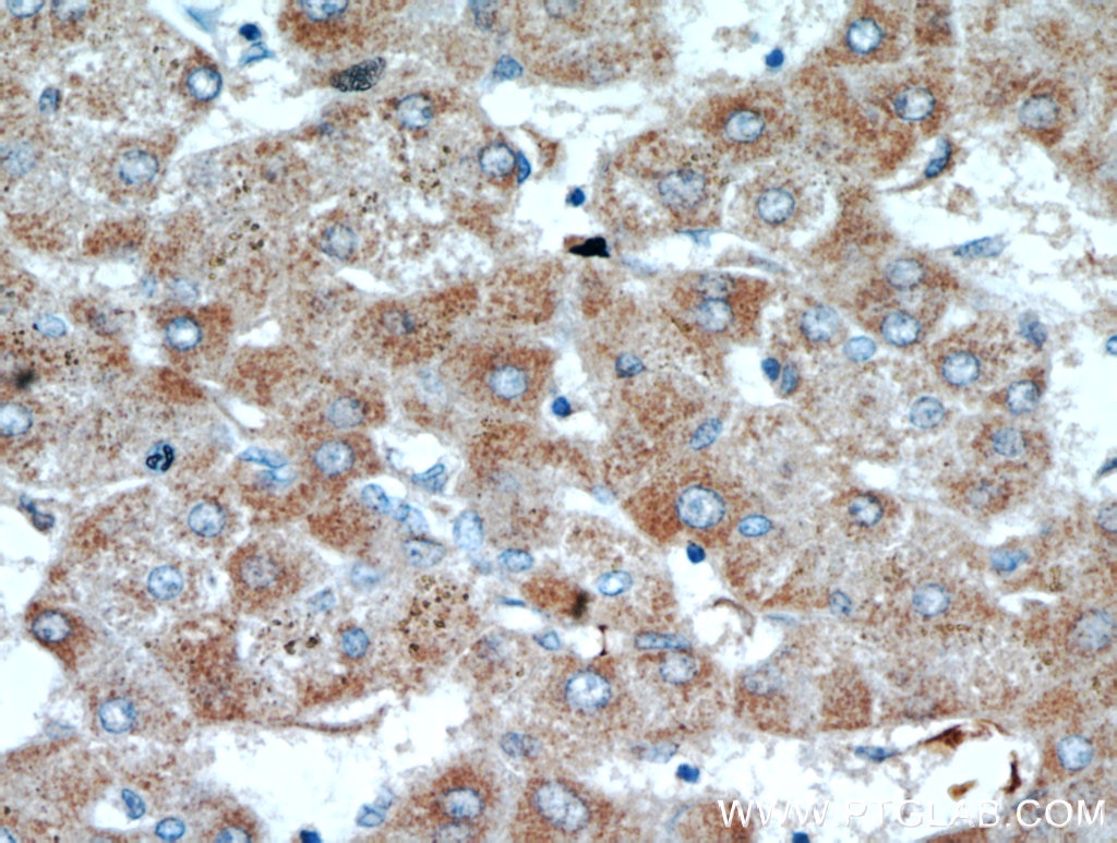 Immunohistochemistry (IHC) staining of human hepatocirrhosis tissue using SCO2 Polyclonal antibody (21223-1-AP)