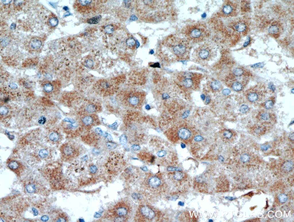 IHC staining of human hepatocirrhosis using 21223-1-AP