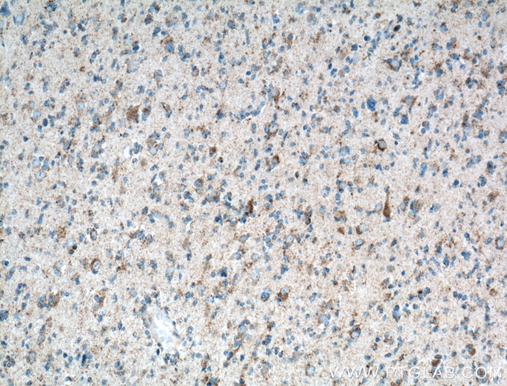 Immunohistochemistry (IHC) staining of human gliomas tissue using OXCT1 Polyclonal antibody (12175-1-AP)