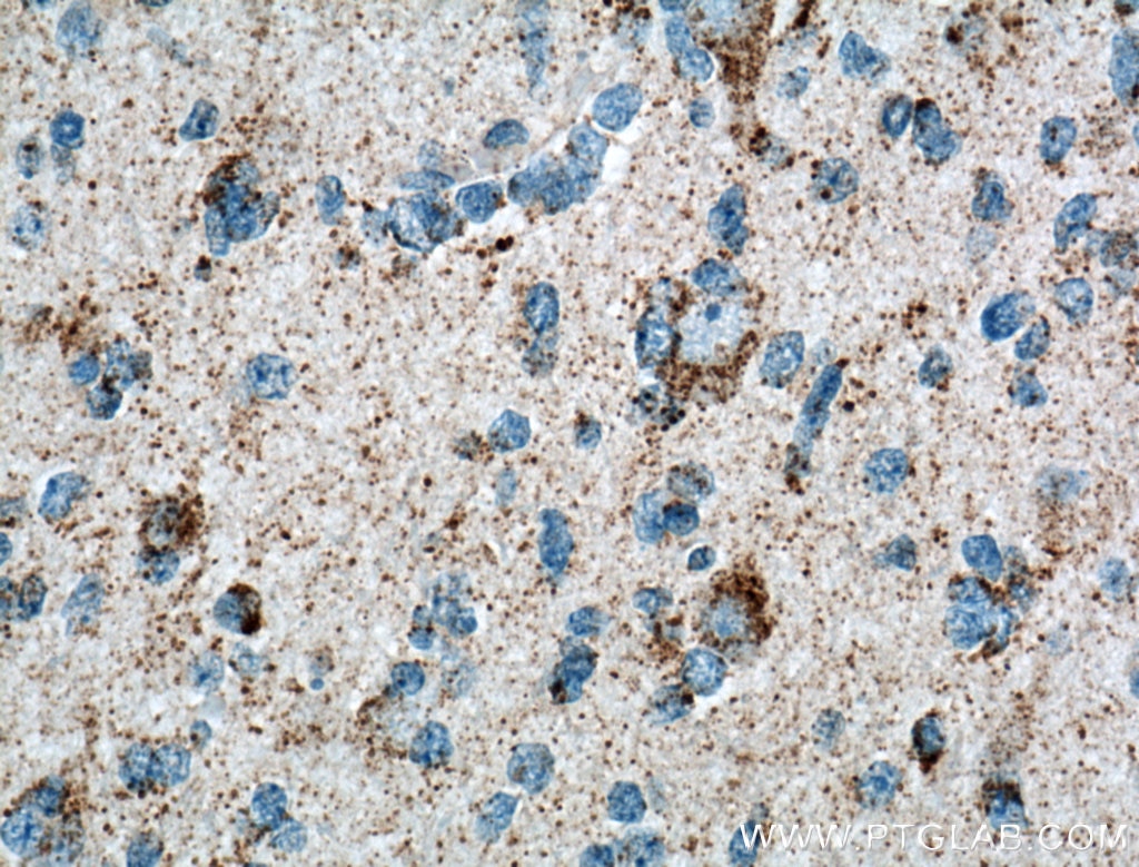 Immunohistochemistry (IHC) staining of human gliomas tissue using OXCT1 Polyclonal antibody (12175-1-AP)