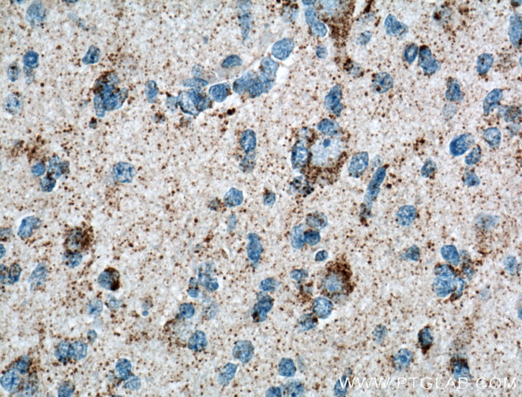 IHC staining of human gliomas using 12175-1-AP