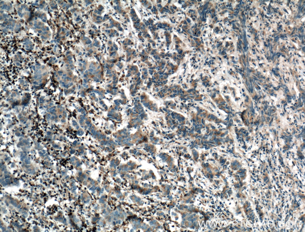 Immunohistochemistry (IHC) staining of human prostate cancer tissue using OXCT1 Polyclonal antibody (12175-1-AP)