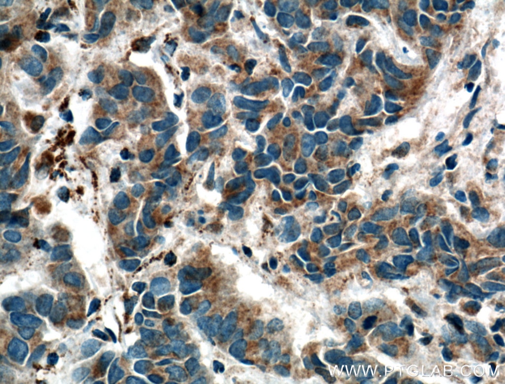 Immunohistochemistry (IHC) staining of human prostate cancer tissue using OXCT1 Polyclonal antibody (12175-1-AP)