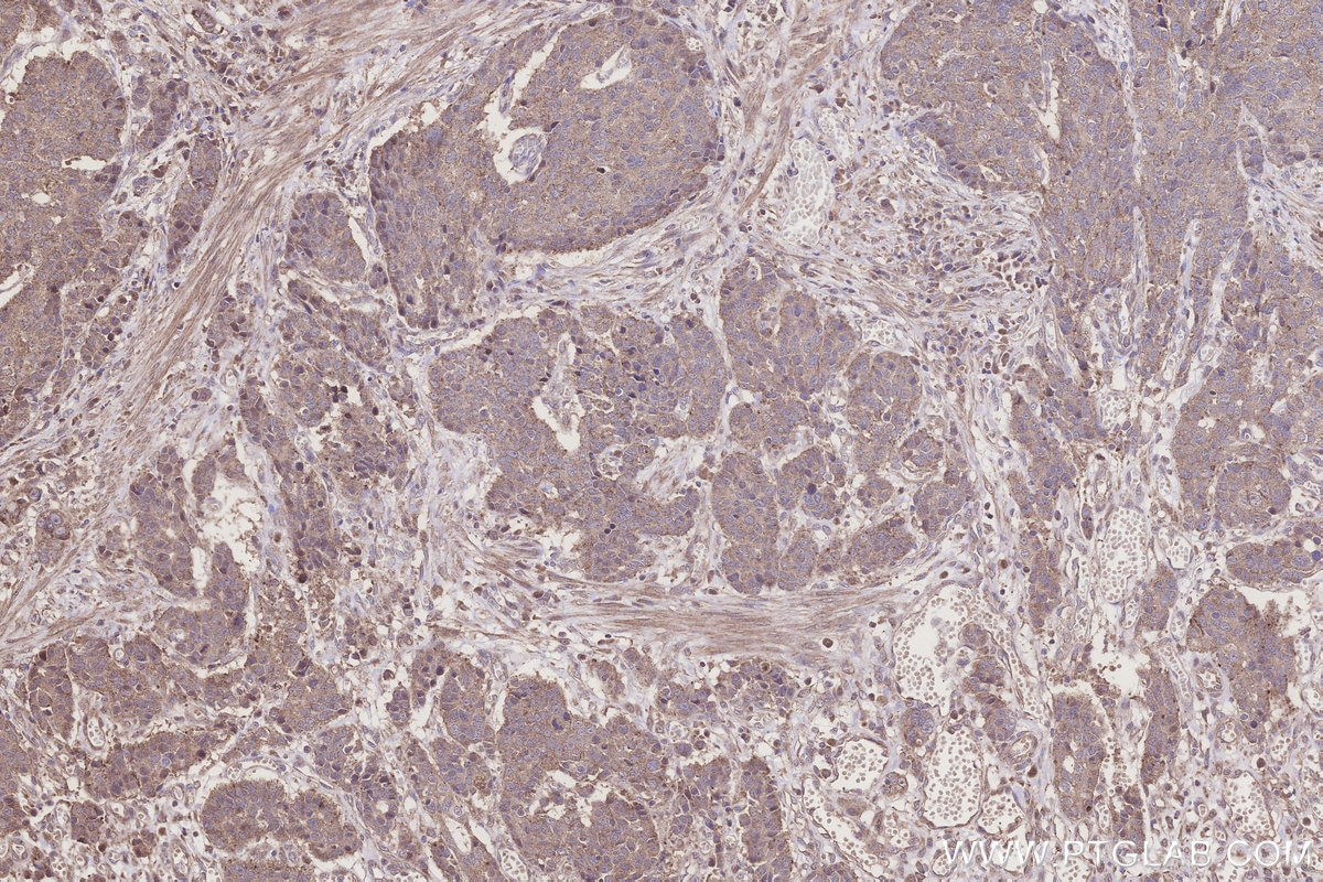 Immunohistochemistry (IHC) staining of human stomach cancer tissue using SCP2/SCPx Polyclonal antibody (23006-1-AP)