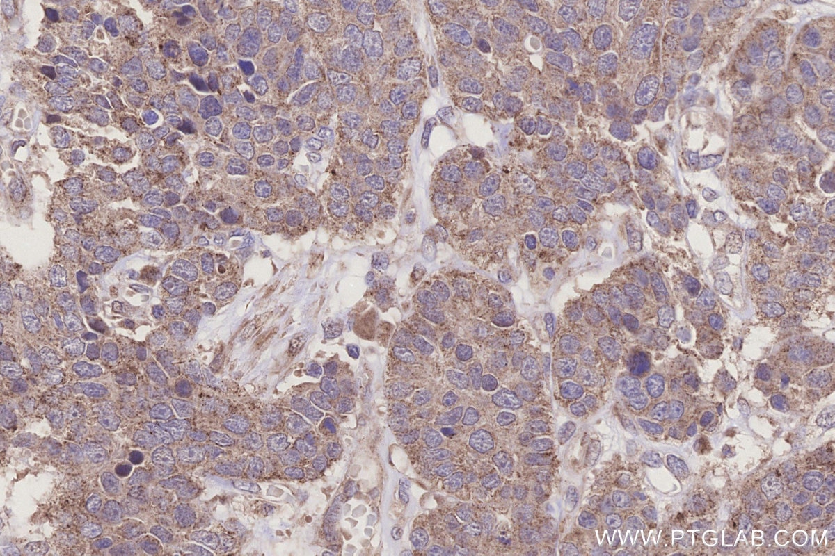 Immunohistochemistry (IHC) staining of human stomach cancer tissue using SCP2/SCPx Polyclonal antibody (23006-1-AP)