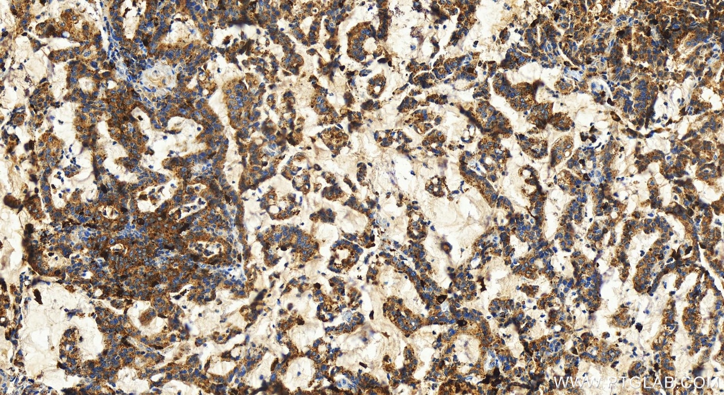 Immunohistochemistry (IHC) staining of human stomach cancer tissue using SCPEP1 Recombinant antibody (83786-4-RR)