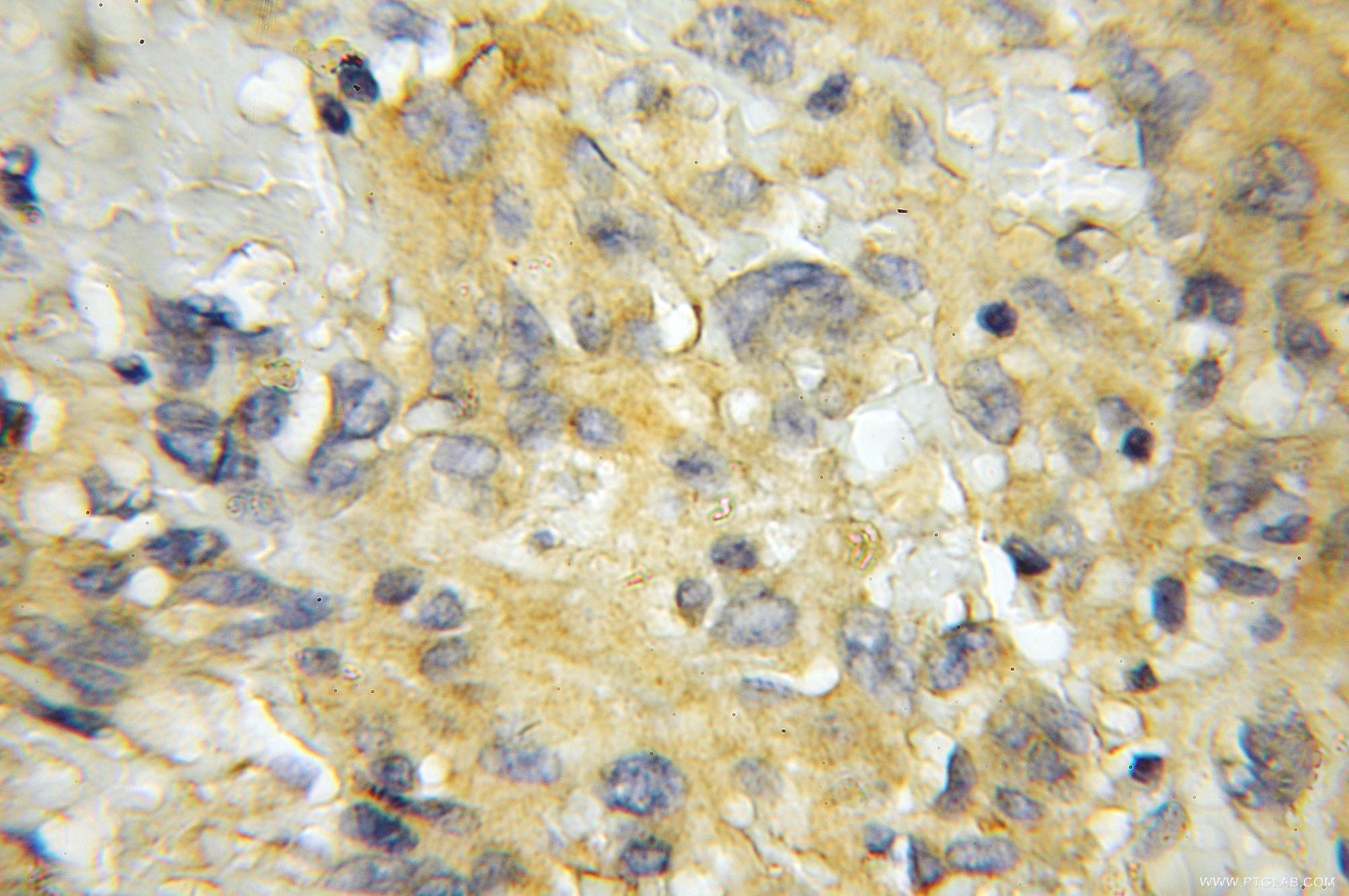 IHC staining of human gliomas using 11485-2-AP