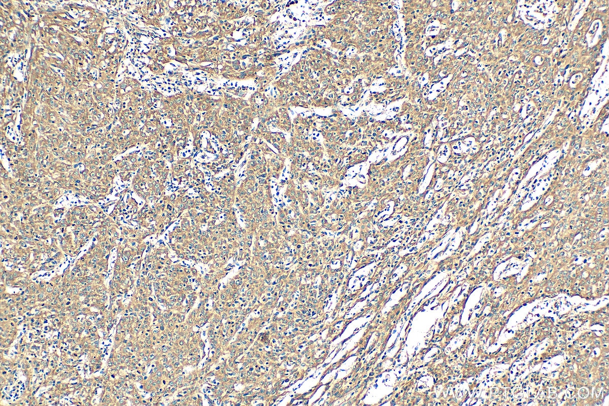 IHC staining of human cervical cancer using 11091-1-AP