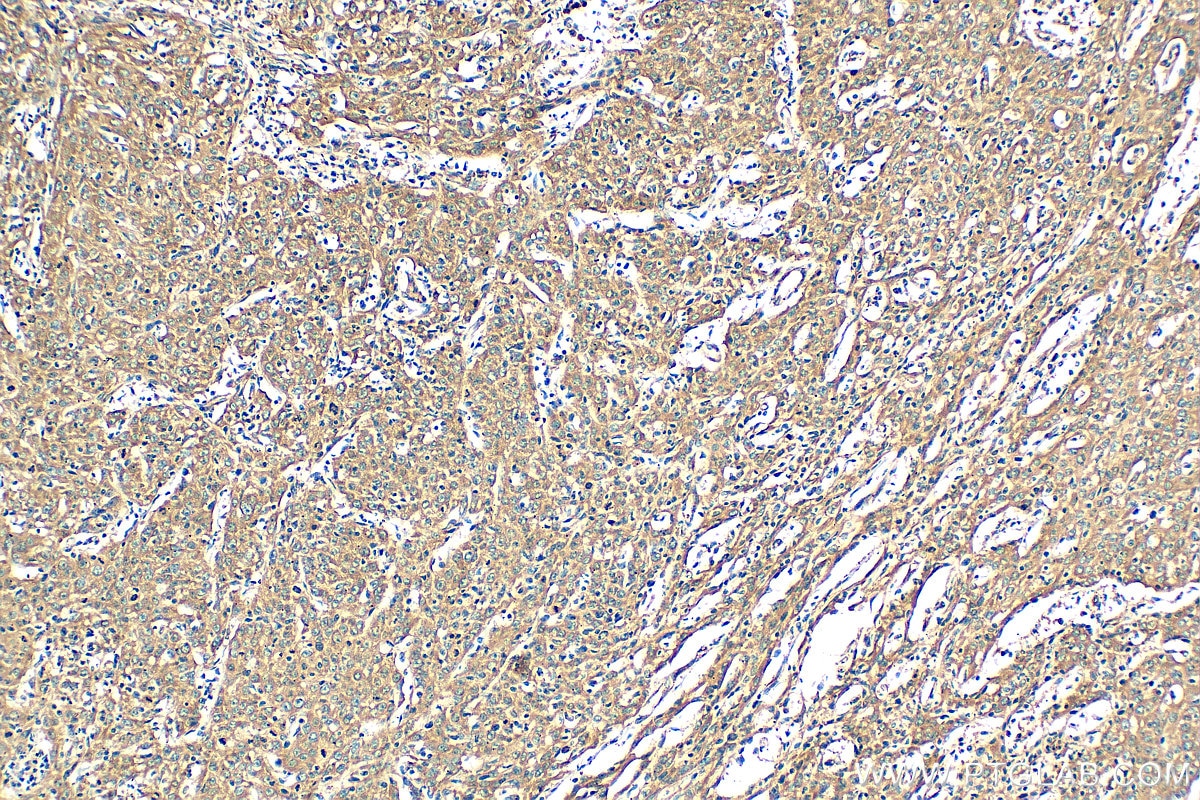 Immunohistochemistry (IHC) staining of human cervical cancer tissue using EMAP II Polyclonal antibody (11091-1-AP)