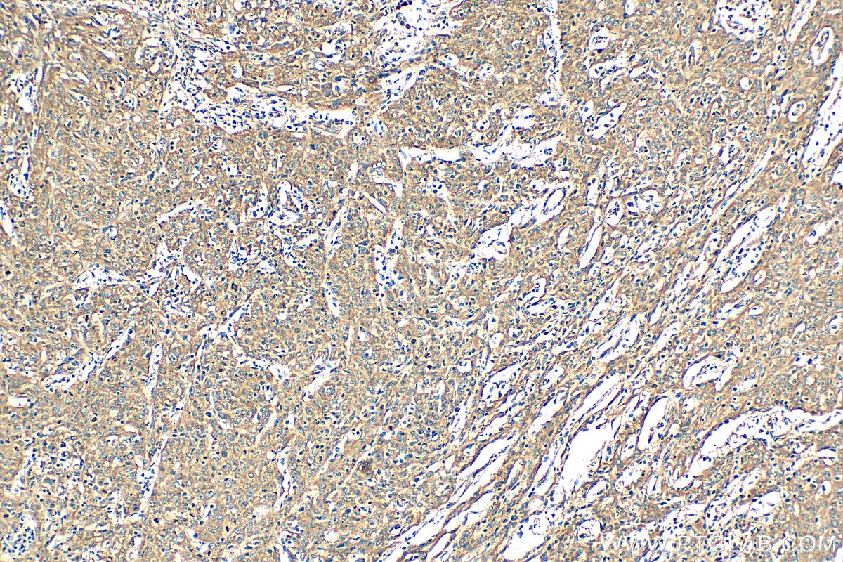 Immunohistochemistry (IHC) staining of human cervical cancer tissue using EMAP II Polyclonal antibody (11091-1-AP)