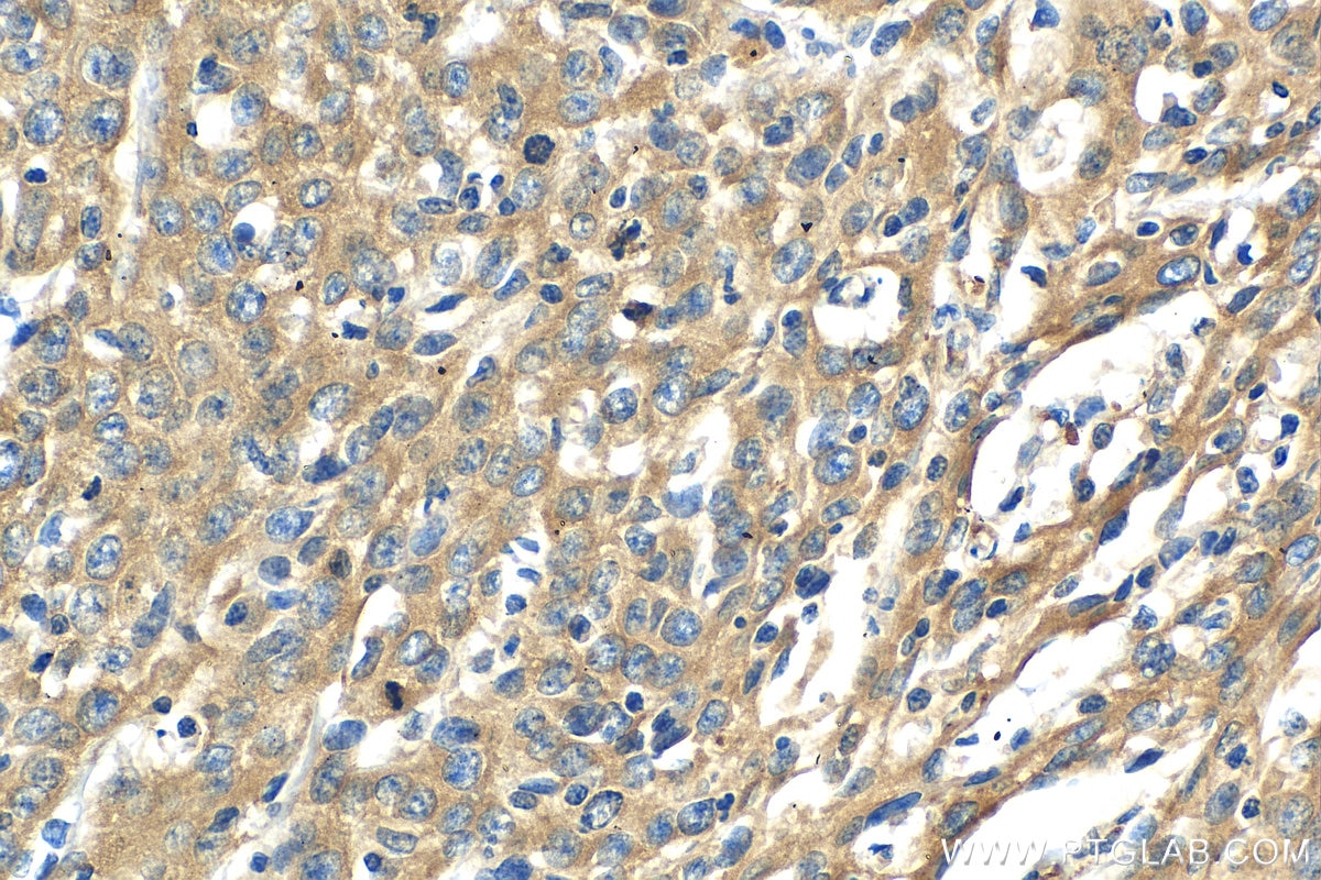 Immunohistochemistry (IHC) staining of human cervical cancer tissue using EMAP II Polyclonal antibody (11091-1-AP)