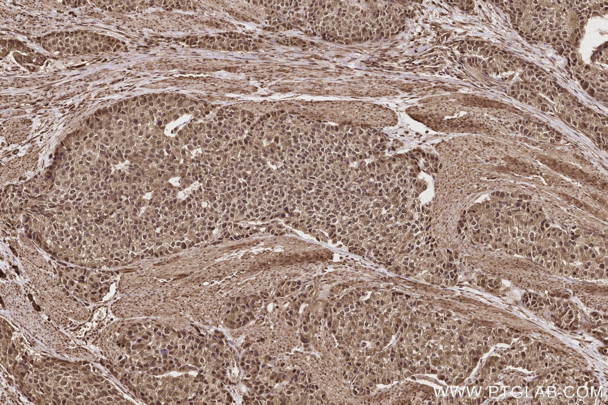 IHC staining of human stomach cancer using 84561-2-RR Immunohistochemistry (IHC) staining of human stomach cancer tissue using SCYL1 Recombinant monoclonal antibody (84561-2-RR)