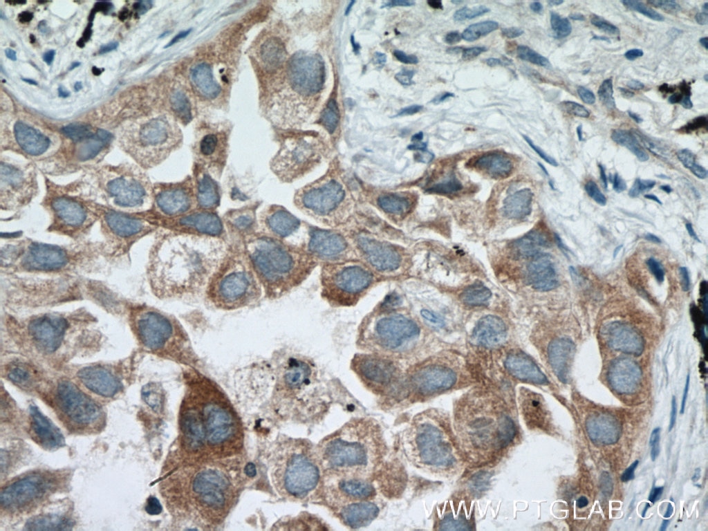 Immunohistochemistry (IHC) staining of human lung cancer tissue using SCYL3 Polyclonal antibody (11249-1-AP)