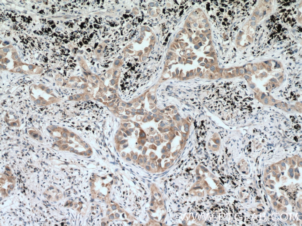 Immunohistochemistry (IHC) staining of human lung cancer tissue using SCYL3 Polyclonal antibody (11249-1-AP)