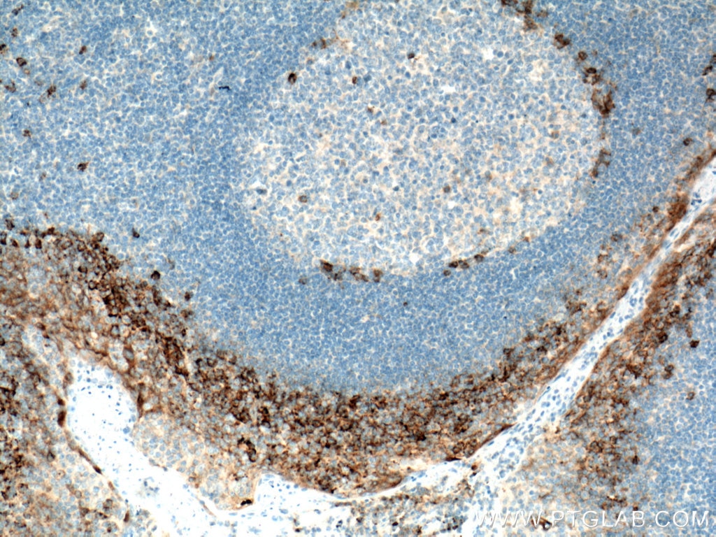 Immunohistochemistry (IHC) staining of human tonsillitis tissue using CD138/Syndecan-1 Polyclonal antibody (10593-1-AP)